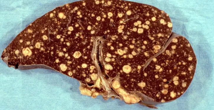 Tuberculosis deaths fall 40%