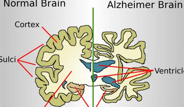 Scientists cure Alzheimer’s in mice, creating hope that humans may be saved from the disease by Hans Bader