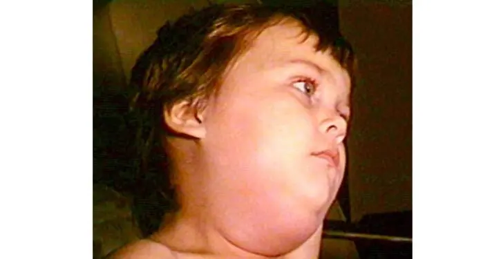 Mumps cases rise in Maryland as vaccination rates fall; federal and state officials urge vaccination