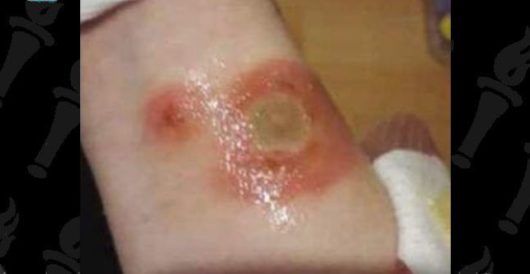 Beware the ‘deodorant challenge,’ the latest fad whereby kids are deliberately injuring themselves by Howard Portnoy