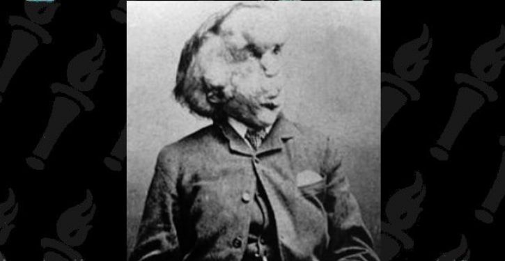 Disability charity slams BBC for casting able-bodied actor in new adaptation of ‘The Elephant Man’