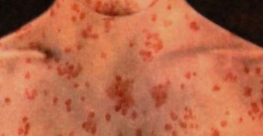 Child dies from measles in Los Angeles by Hans Bader