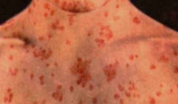 Child dies from measles in Los Angeles by Hans Bader