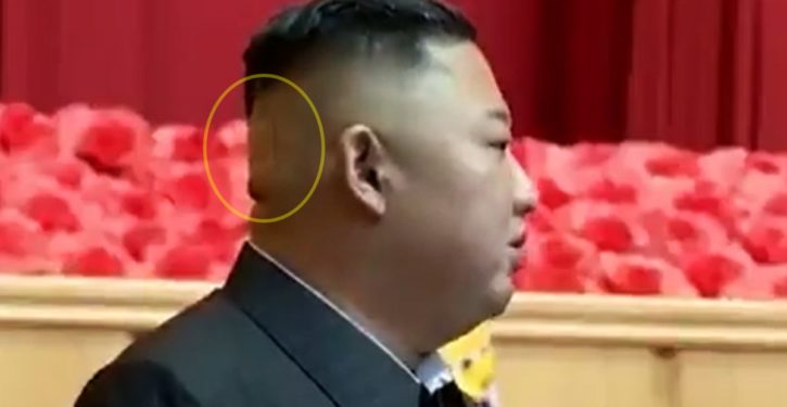 Speculation abounds over large bandage seen on back of Kim Jong-Un’s head