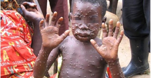 Here’s What The New African ‘Pox’ Sweeping The West Actually Looks Like by Daily Caller News Foundation