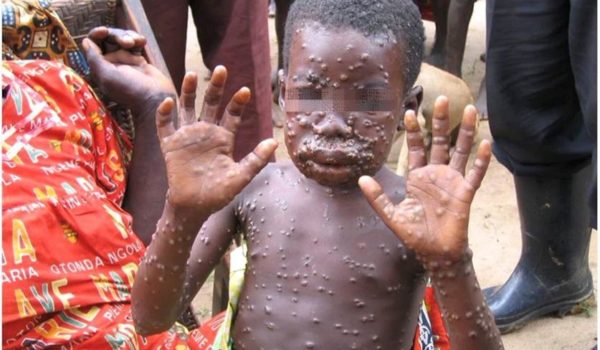Here’s What The New African ‘Pox’ Sweeping The West Actually Looks Like by Daily Caller News Foundation