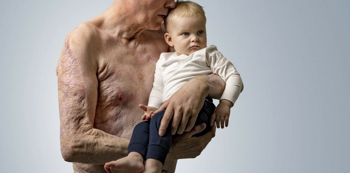 Fishman Skin grafts made of fish scales save burn victim Liberty