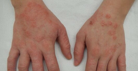 The curse of severe eczema may be coming to an end by LU Staff