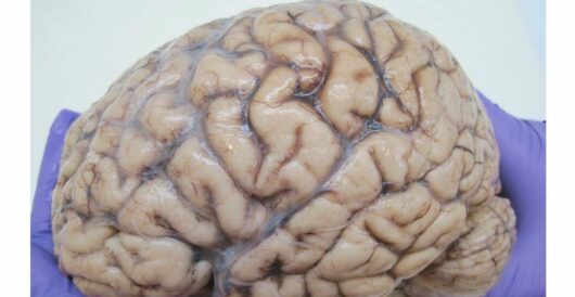 Brain implants could fight depression by LU Staff