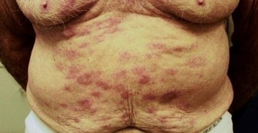 172,717 new cases of leprosy were detected in 2024, a 5.5% decline from 2023 by Hans Bader